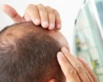 Ilustrasi seseorang memijat kulit kepala untuk merangsang pertumbuhan rambut di area botak.