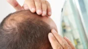 Ilustrasi seseorang memijat kulit kepala untuk merangsang pertumbuhan rambut di area botak.